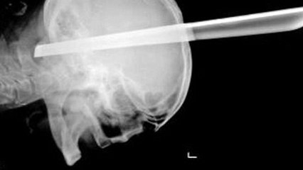 Man Gets Bar Stool Leg Through Brain and Lives!
