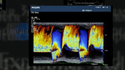 Philips iE33 Echocardiography System For Sale At Ideal Medical