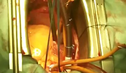 Opération à coeur ouvert