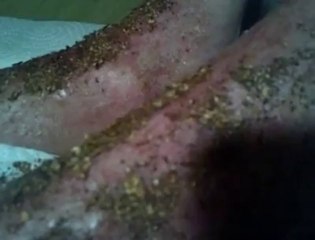 Jamila Laaraj (Chimay): "J'ai trouvé le remède pour guérir le psoriasis"