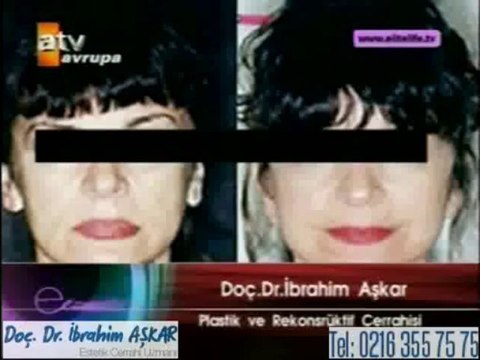 Yüz germe ameliyatı yeterli olmazsa boyunda germe işlemi yapılır mı