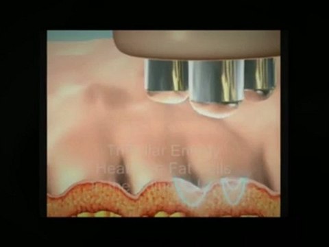 Cellulite Fat Reduction-Pompano