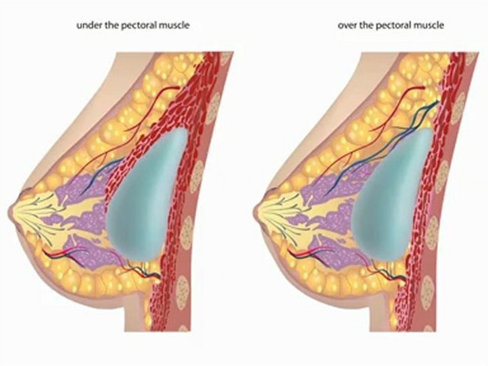 Mommy Makeover at Boulder Plastic Surgery in Boulder, CO
