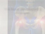 Avasular Necrosis and AVN Treatment for New Jersey - Avoid Hip Replacement