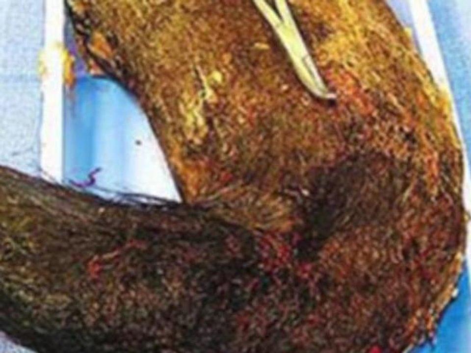 Four Pound Chalky Hairball Removed From Girl's Stomach