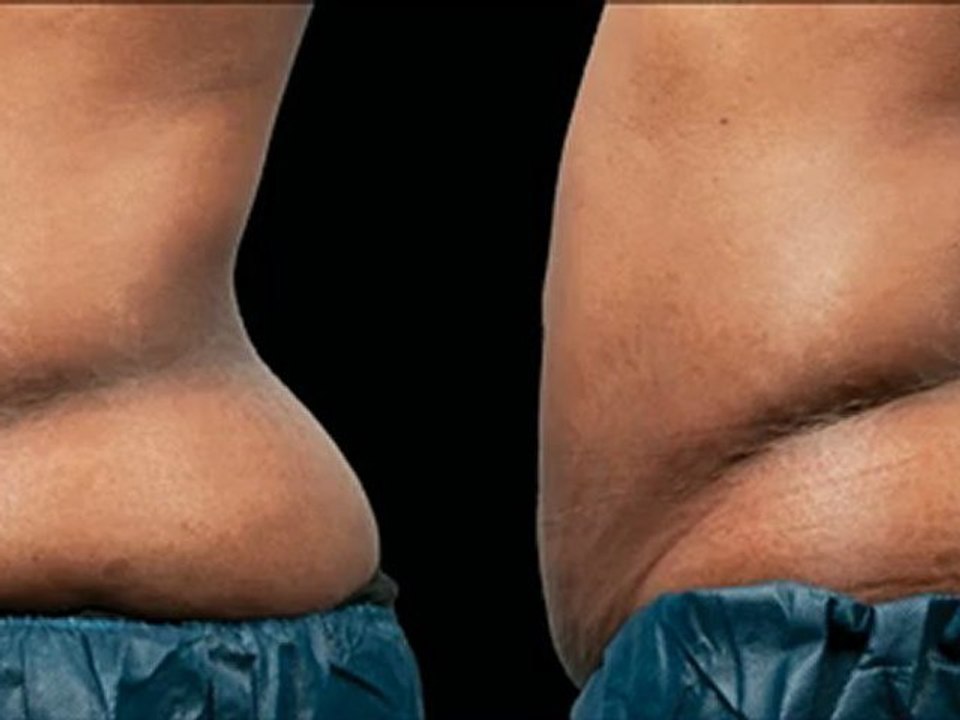 Coolsculpting® Female Abdomen - 120 Days