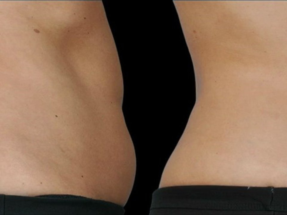 Coolsculpting® Female Abdomen - 75 Days