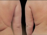 Coolsculpting® Female LoveHandle - 75 Days