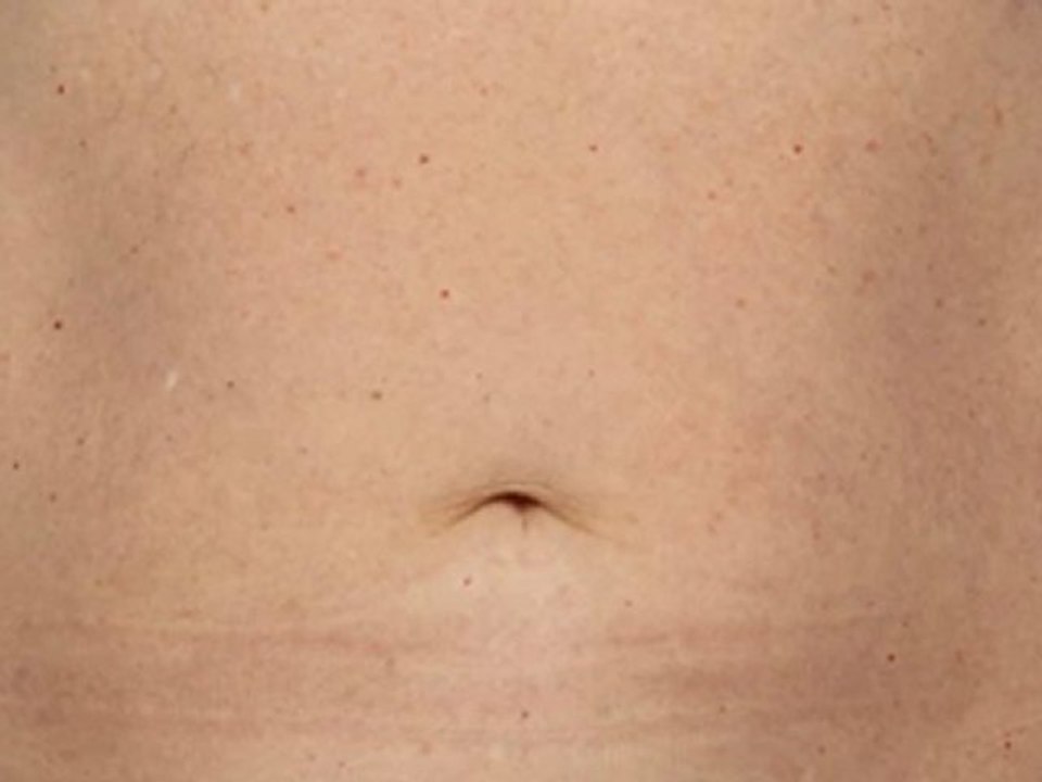 Coolsculpting® Female Abdomen - 120 Days
