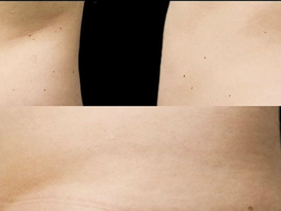 Coolsculpting® Female Abdomen - 120 Days