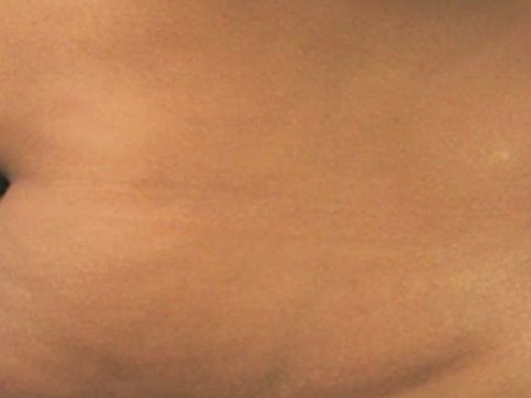 Coolsculpting® Female Abdomen - 60 Days