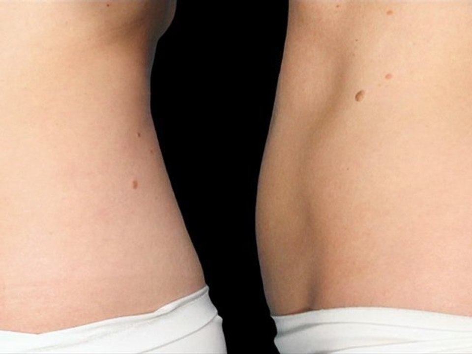 Coolsculpting® Female Abdomen - 40 Days