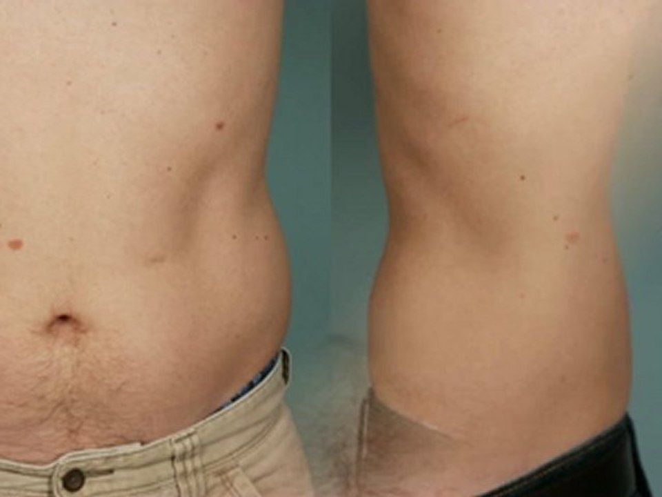 Coolsculpting® Male LoveHandle - 90 Days