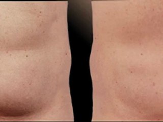 Coolsculpting® Male Abdomen - 90 Days