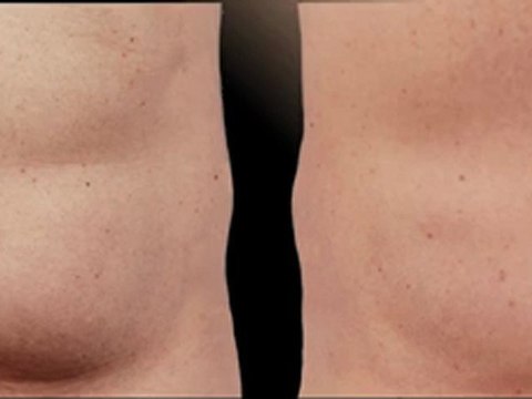 Coolsculpting® Male Abdomen - 90 Days