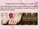 Toenail Fungus Removal Los Angeles