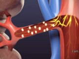 Un tratamiento con radiofrecuencia en las arterias renales consigue controlar la hipertensión