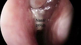What a nasal polyp looks like
