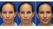 Before & After Seattle Rhinoplasty (Nose job) | Crooked Nose and Chin Augmentation