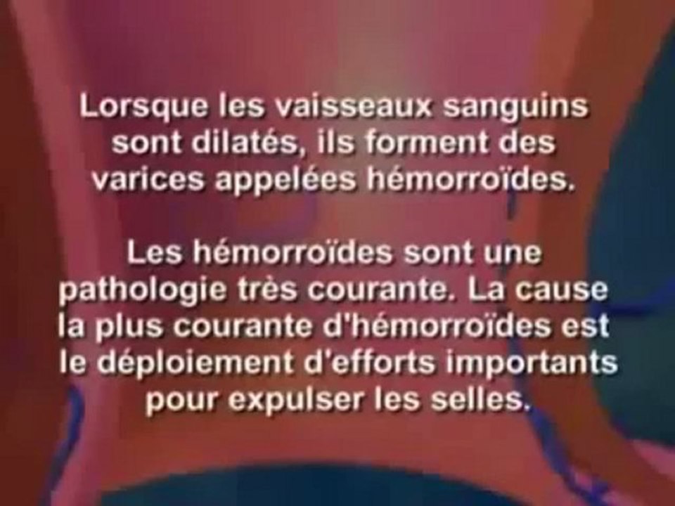 Traitement des hémorroïdes: Comment soulager les hémorroïdes externes et internes