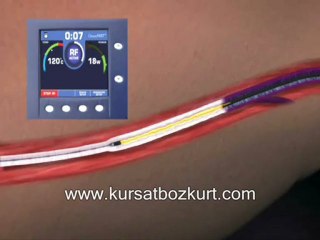What İs The  Treatment  Of Big Varicose ,Prof.Dr.Kurşat Bozkurt, www.varis.net, +90 212 215 53 43, +90 532 246 00 01