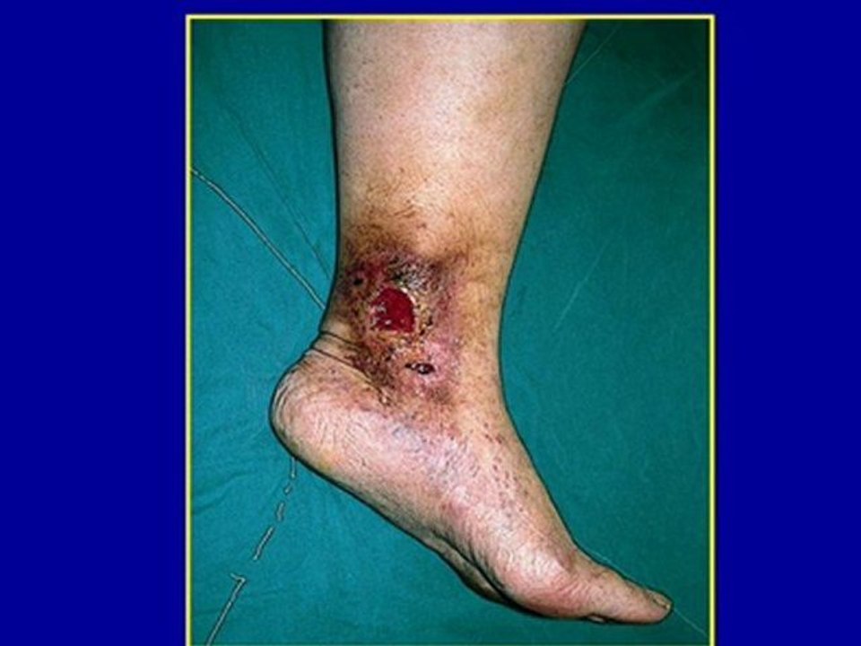 How  can we classify   varicose veins ?, Prof.Dr.Kurşat Bozkurt, www.varis.net, +90 212 215 53 43, +90 532 246 00 01