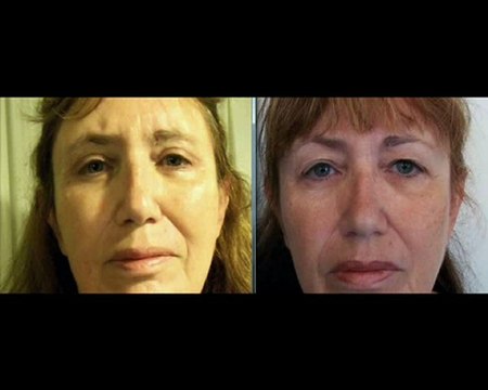 ד ר אבישי וינברגר - ניתוח אף והרמת עפעפיים