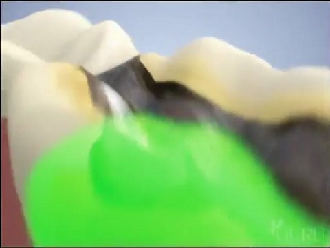 Cosmetic Dentist Fairfield CT Dr. Mariana Conant - What Happens With A Fracture Tooth