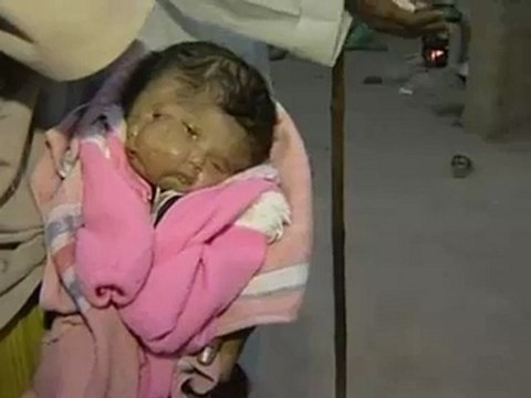 Un enfant né avec 2 visages et 4 oeils