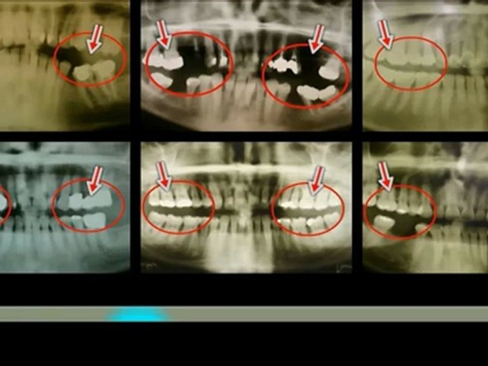 Plaque Removal in langhorne, Penndel,Levittown