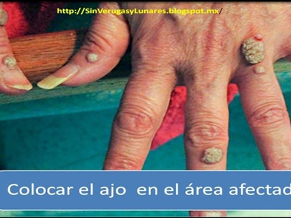 Como Eliminar  Las Verrugas y Lunares de Manera Natural y Definitiva