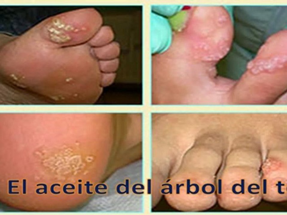 Tratamiento Verrugas Planas-Tratamiento Para Las Verrugas Genitales