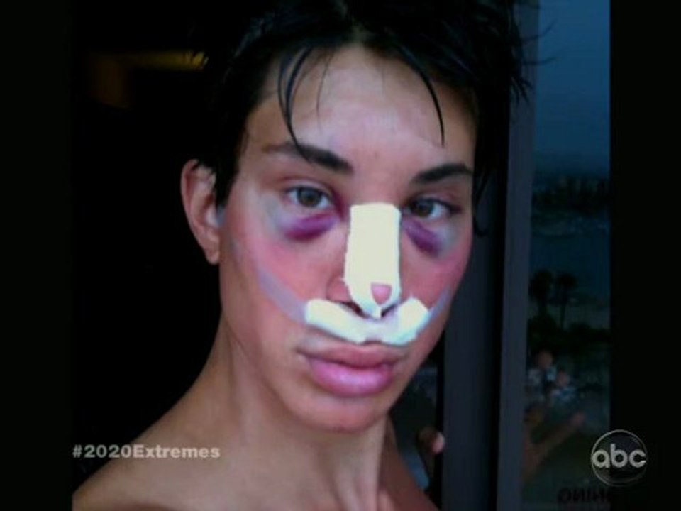 Extreme Plastic Surgery