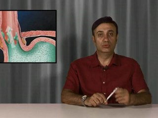 Hamilelikte reflü Hastalığı niçin olur? Tedavisi nasıl yapılır?