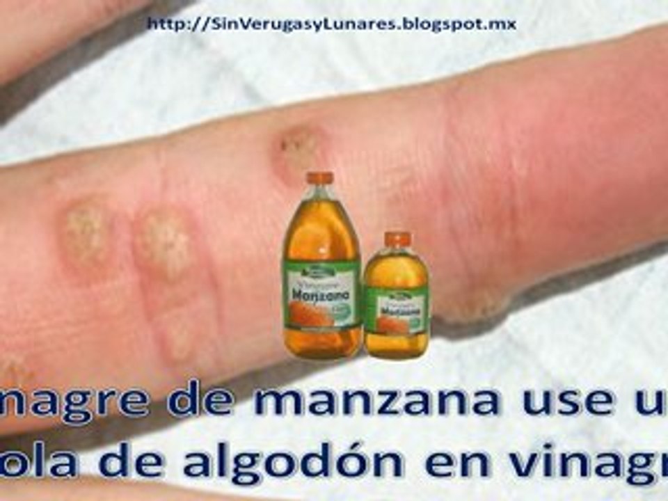 Como Eliminar las Verrugas-Eliminar Verrugas