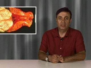 Myom ve polipler tüp bebek tedavisinde sorun yaratır mı?