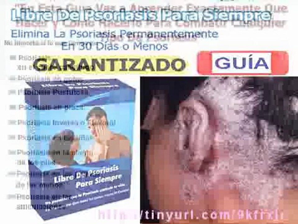 CÓMO CURAR LA PSORIASIS EN 30 DÍAS O MENOS