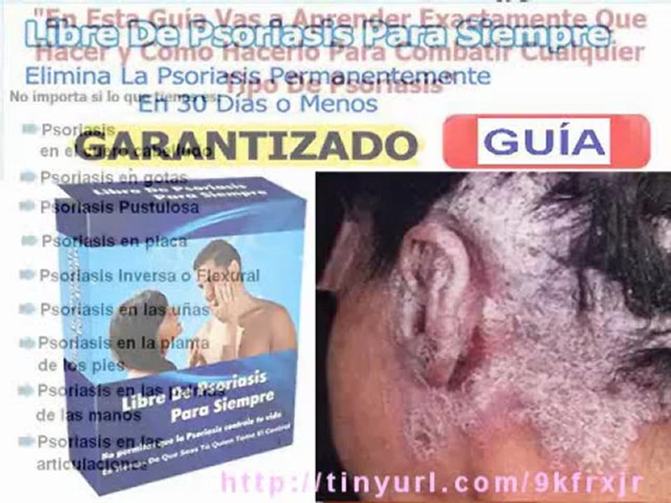 CÓMO CURAR LA PSORIASIS EN 30 DÍAS O MENOS