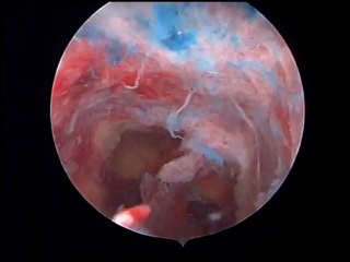 Histeroskopik uterus gözlemi, myom ve polip operasyonu ve yapışıklık (Asherman) açılması operasyonu