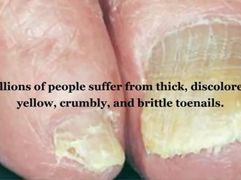 Toenail Fungus Cure with Pinpoint Laser Treatment- Call us at 904-739-9129