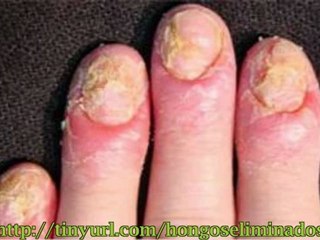 Infecciones por hongos no mas