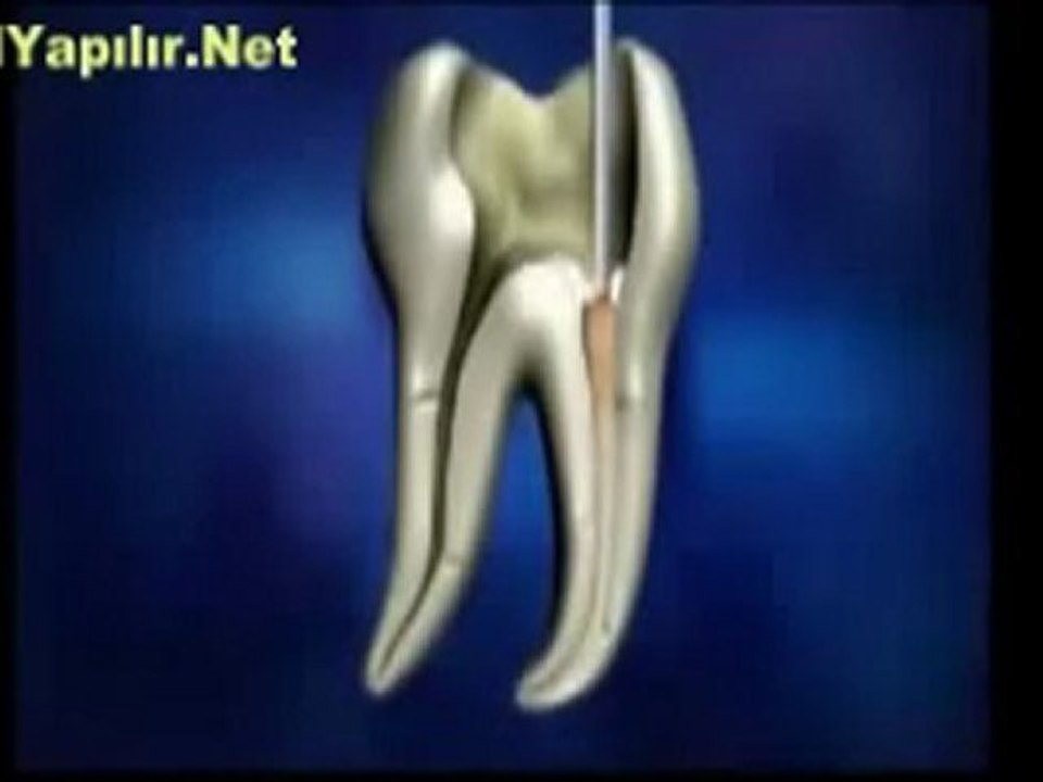 Kanal Tedavisi Nasıl Yapılır? | NasılYapılır.Net |