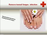 Get beautiful toenails by treating toenail fungus