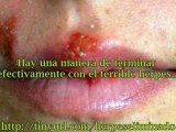 Tratamientos Naturales para el Herpes