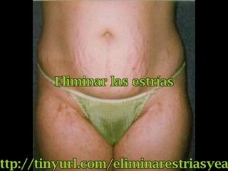 Como Puedo Eliminar las Estrias