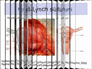 Gebelikte Kanama-Atoni Kanaması