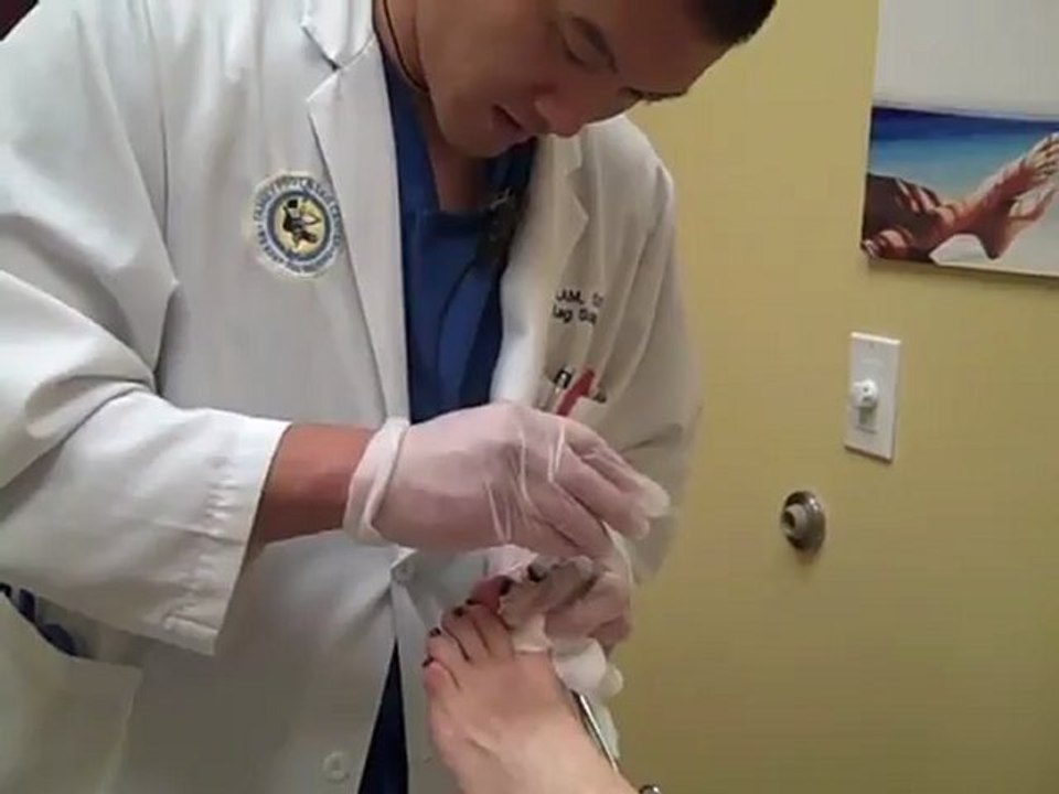 Chronic Ingrown Toenail Surgery - Naples Podiatrist / Family Foot and Leg Center