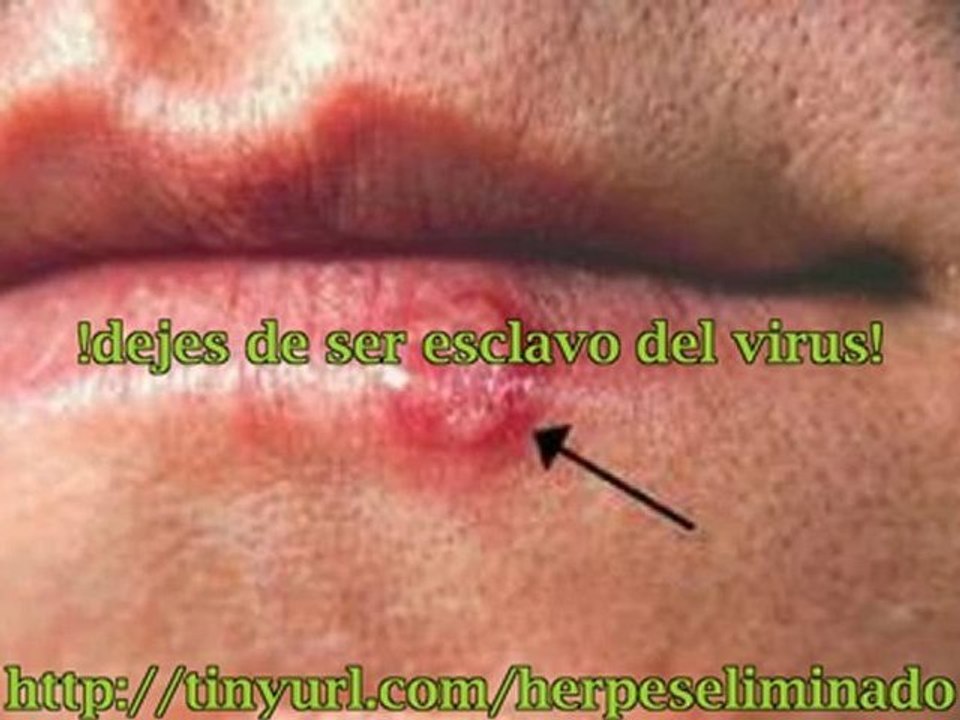 Remedios naturales para el herpes labial