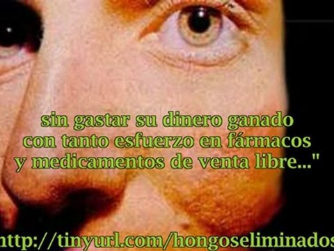 Tratamientos naturales para hongos en las uñas