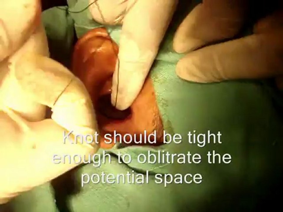 Button method for hematoma pinna- Dr Arfat Jawaid ENT specialist in Karachi